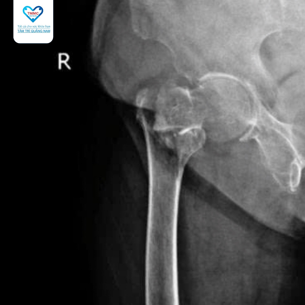 gay-mau-xuong-chuyen-2