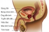 Phòng tránh ung thư tiền liệt tuyến như thế nào là hiệu quả?
