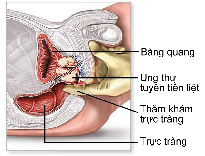 ung-thu-tuyen-tien-liet_1