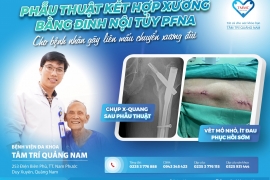 PHẪU THUẬT KẾT HỢP XƯƠNG BẰNG ĐINH NỘI TỦY PFNA CHO BỆNH NHÂN GÃY LIÊN MẤU CHUYỂN XƯƠNG ĐÙI