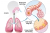 Bệnh phổi tắc nghẽn mạn tính (COPD)