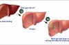 Tầm soát vi rút viêm gan C (Hepatitis C virus screening)