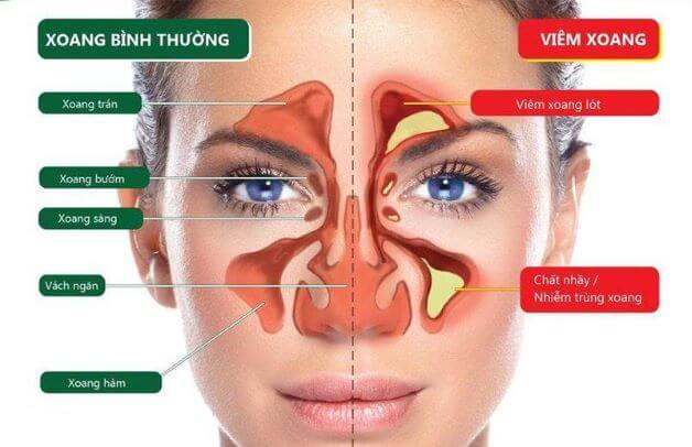 viem-da-xoang-man-tinh